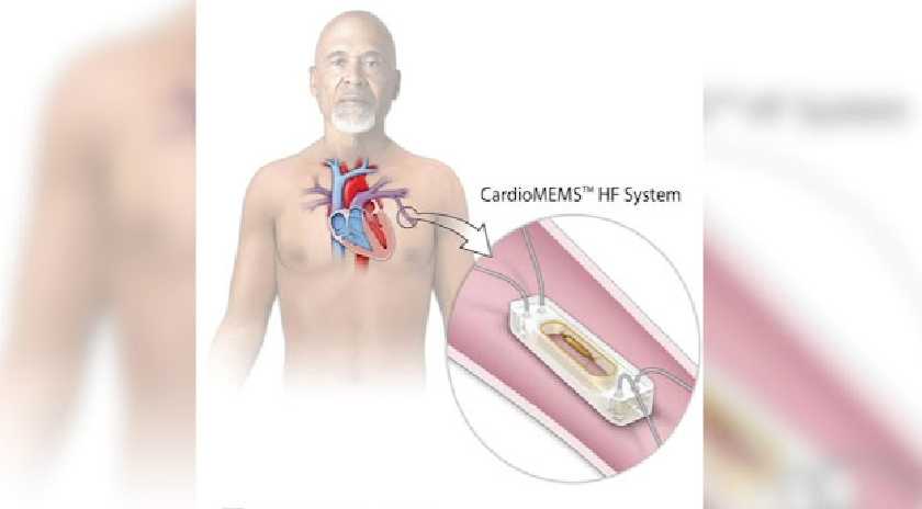 Πρωτοποριακή εμφύτευση συσκευής CardioMEMS™ στο Βοστάνειο – Σημαντικό βήμα για την ιατρική καινοτομία στο Αιγαίο